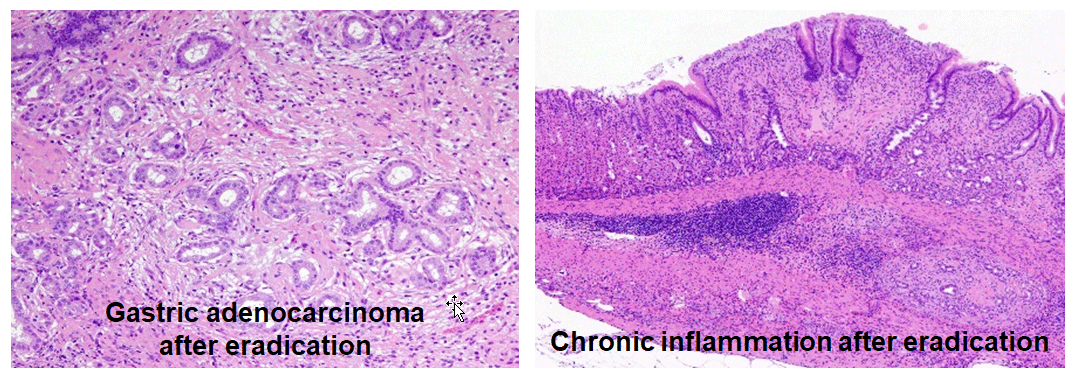 Gastric adenocarcinoma after eradication / Chronic inflammation after eradication